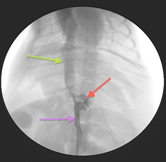 Intraoperative fluoroscopy (portovenogram)